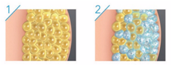 Het proces van cryolipolyse