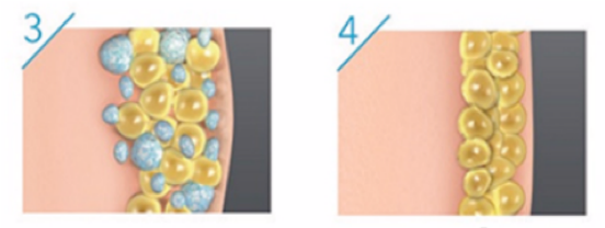 Het proces van cryolipolyse