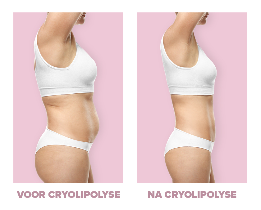 Before and after cryolipolyse vetbevriezing